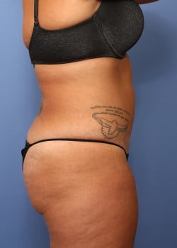 Brazilian Butt Lift