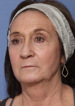 After Image: Laser Resurfacing - left-front-oblique