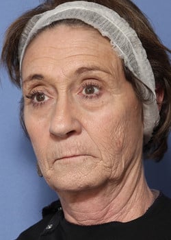 Before Image: Laser Resurfacing - left-front-oblique