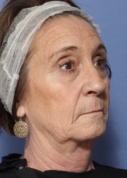 Laser Resurfacing