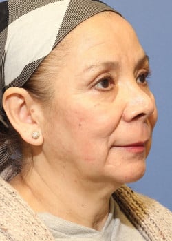 After Image: Laser Resurfacing - right-front-oblique