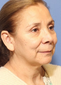 Before Image: Laser Resurfacing - right-front-oblique
