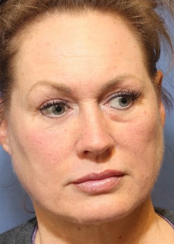 After Image: Laser Resurfacing - front