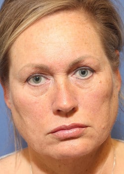 Before Image: Laser Resurfacing - front