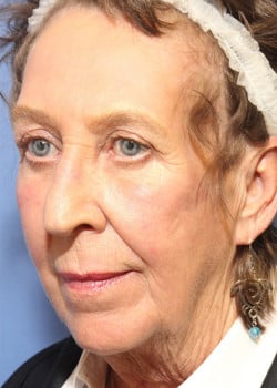 After Image: Laser Resurfacing - left-front-oblique