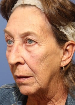 Before Image: Laser Resurfacing - left-front-oblique