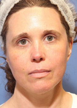 After Image: Fusion Facelift Case 6 - front