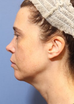 Before Image: Fusion Facelift Case 6 - left-side
