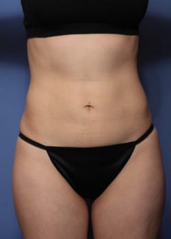 After Image: Liteshape Laser Liposuction - front