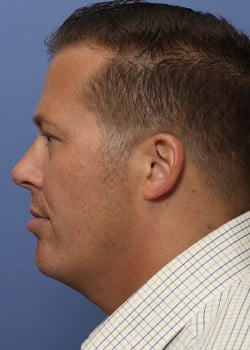 Liteshape Laser Liposuction Before & After Photos - Salzman Cosmetic Surgery & Spa Liteshape Laser Liposuction Before & After Photos - Salzman Cosmetic Surgery & Spa