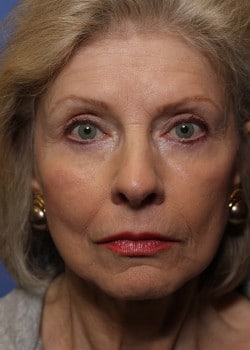 After Image: Fusion Facelift Case 7 - front