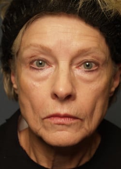Before Image: Fusion Facelift Case 7 - front