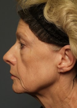 Before Image: Fusion Facelift Case 7 - other