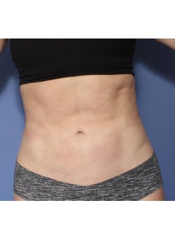Liposuction