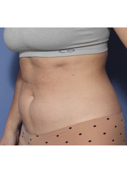 Before Image: Liposuction - left-front-oblique