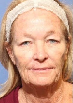 Before Image: Fusion Facelift Case 8 - front