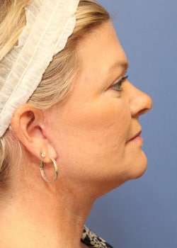 After Image: Fusion Facelift Case 9 - right-side
