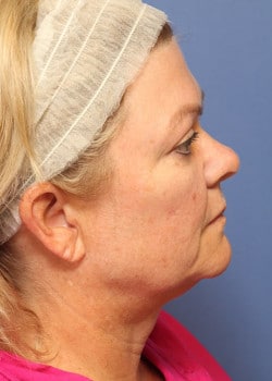 Before Image: Fusion Facelift Case 9 - right-side