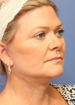 After Image: Fusion Facelift Case 9 - right-front-oblique