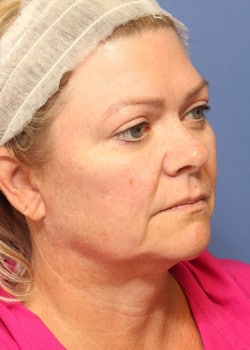 Before Image: Fusion Facelift Case 9 - right-front-oblique