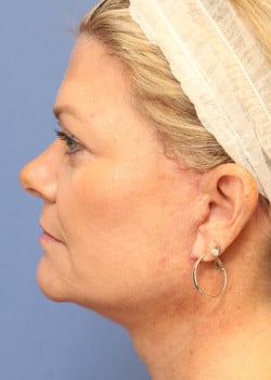 After Image: Fusion Facelift Case 9 - left-side
