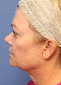 Before Image: Fusion Facelift Case 9 - left-side