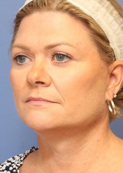 After Image: Fusion Facelift Case 9 - left-front-oblique
