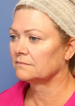 Before Image: Fusion Facelift Case 9 - left-front-oblique