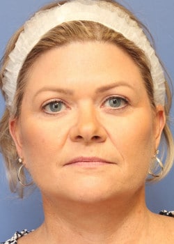 After Image: Fusion Facelift Case 9 - front