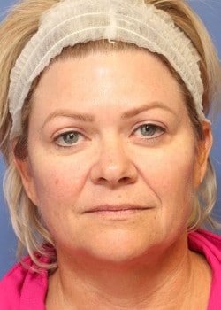 Before Image: Fusion Facelift Case 9 - front